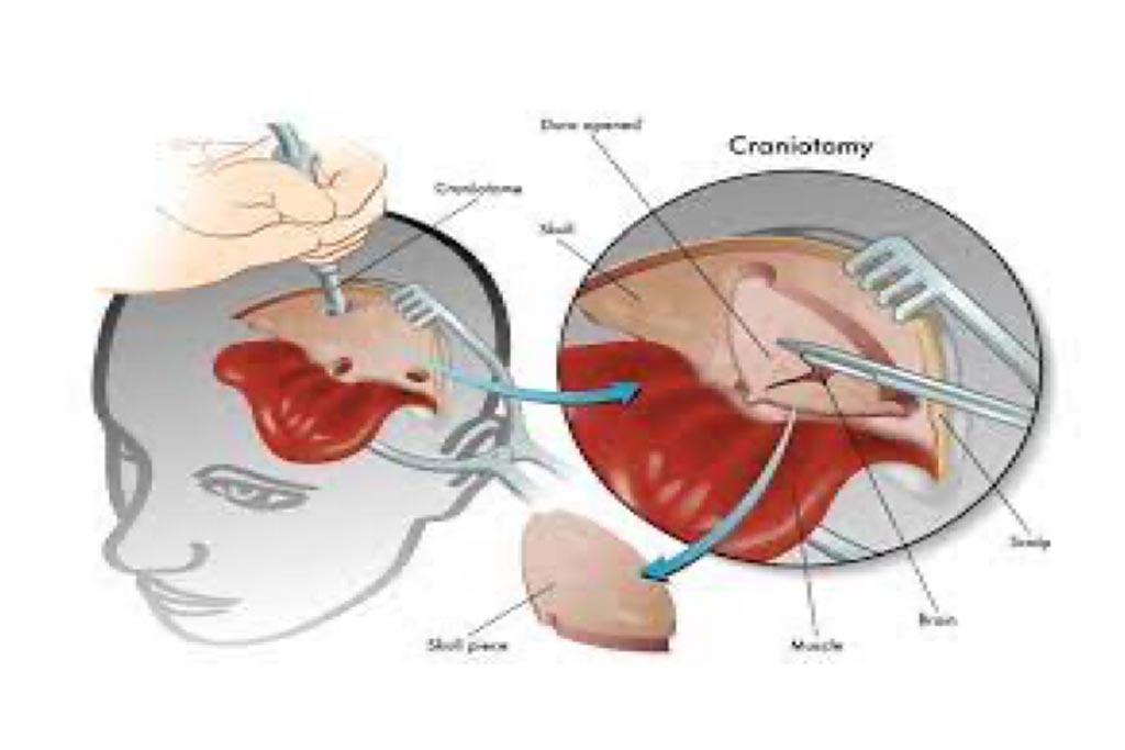 Craniotomy